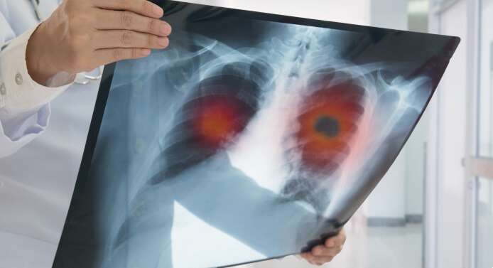 Cáncer de pulmón Cáncer de pulmón