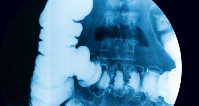Cáncer de colon o colorectal Cáncer de colon o colorectal